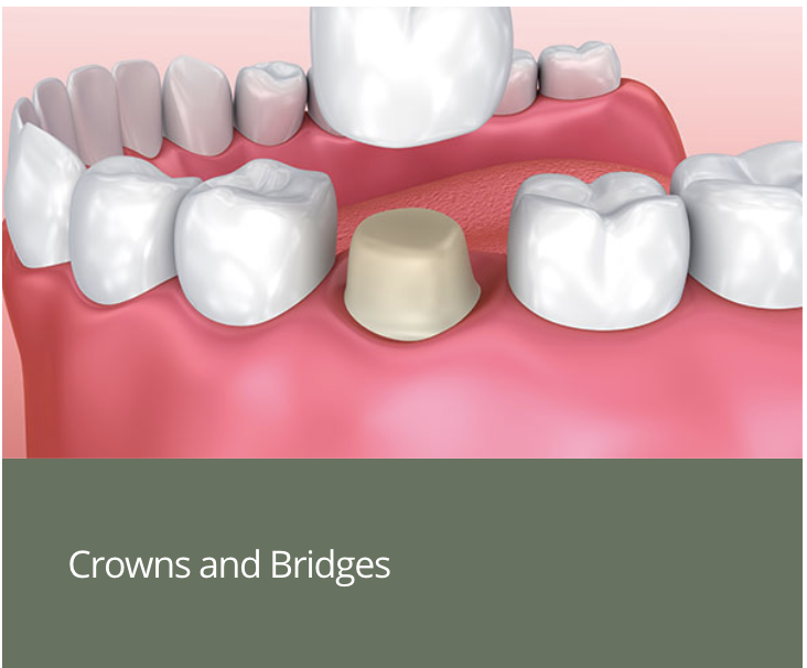 crowns and bridges