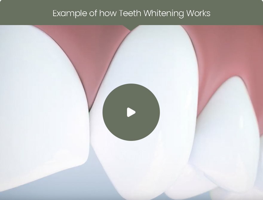 Teeth Whitening | Dr. John M. Cherry, Jr., DMD - Brandon Dentist | null