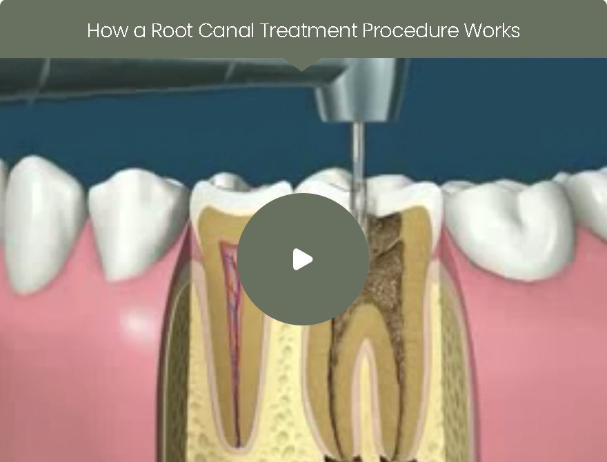Root Canals | Dr. John M. Cherry, Jr., DMD - Brandon Dentist | null