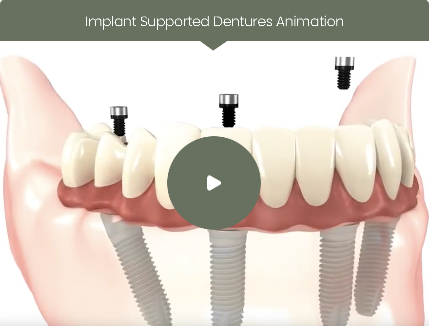 Excellent Implant-Supported Dentures in Brandon, FL | Dr. John M. Cherry, Jr., DMD - Brandon Dentist | implant-supported dentures,dental implants,brandon null