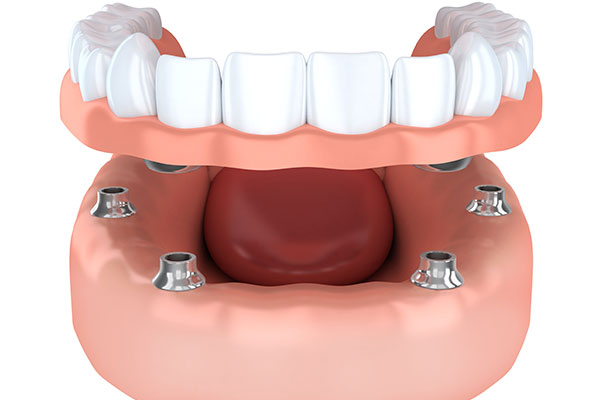 Smile Makeover With Your Brandon, FL Cosmetic Dentistry | Dr. John M. Cherry, Jr., DMD - Brandon Dentist | brandon,cosmetic dentistry 3d model of bottom jaw smile makeover