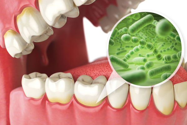 Smile Makeover With Your Brandon, FL Cosmetic Dentistry | Dr. John M. Cherry, Jr., DMD - Brandon Dentist | brandon,cosmetic dentistry 3d model showing bacteria affecting roots of teeth and gums
