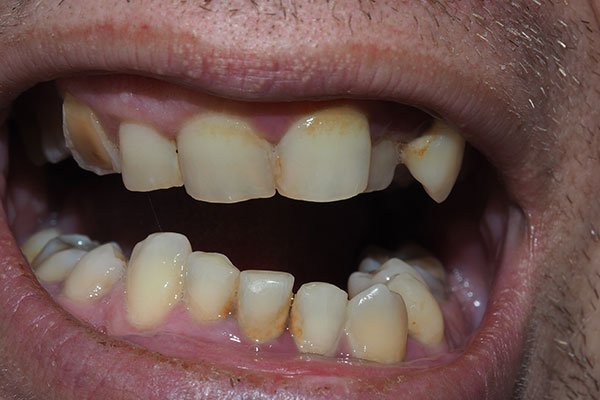 dirty crooked teeth in need of tooth extraction