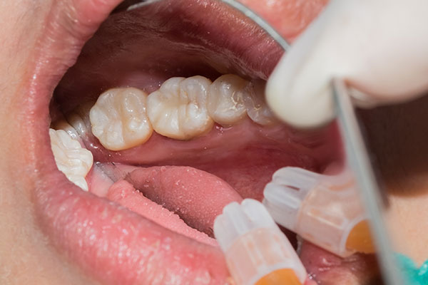 Cosmetic Dentistry | Dr. John M. Cherry, Jr., DMD - Brandon Dentist | cosmetic dentistry open mouth being operated on for cosmetic dentistry