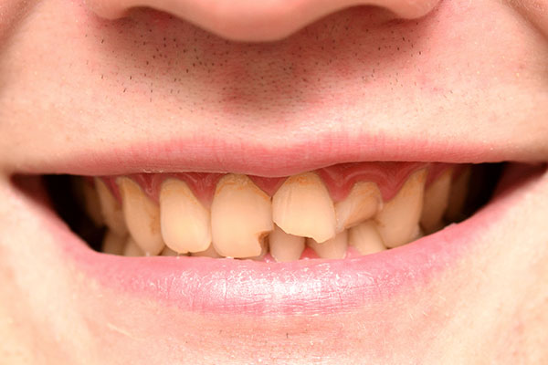 yellow chipped crooked teeth need cosmetic dentistry