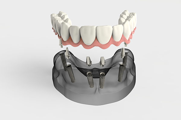 3d model of dentures