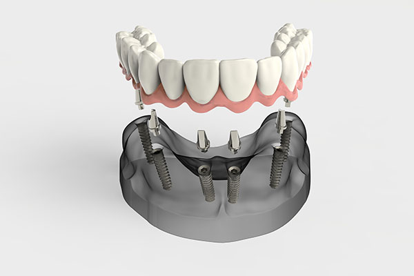 Dentures | Dr. John M. Cherry, Jr., DMD - Brandon Dentist | 3d model of dentures