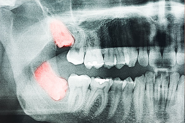 left side of xray of teeth needing tooth extraction