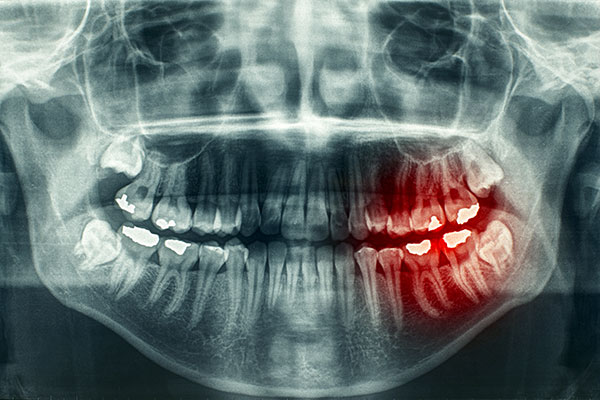 xray of infected teeth in need of tooth extraction