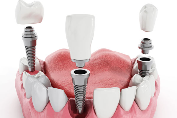 3d model of dental implants for smile makeover