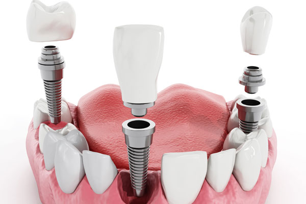 Smile Makeover With Your Brandon, FL Cosmetic Dentistry | Dr. John M. Cherry, Jr., DMD - Brandon Dentist | brandon,cosmetic dentistry 3d model of dental implants for smile makeover