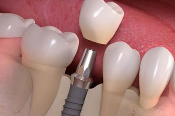 3d graphic of crown being put on the post of dental implants
