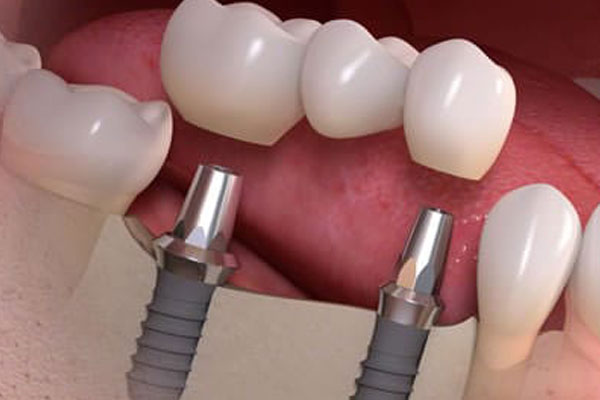 3d graphic of the crowns and posts of dental implants