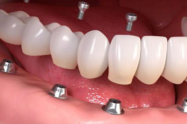 3d graphic of dental implants