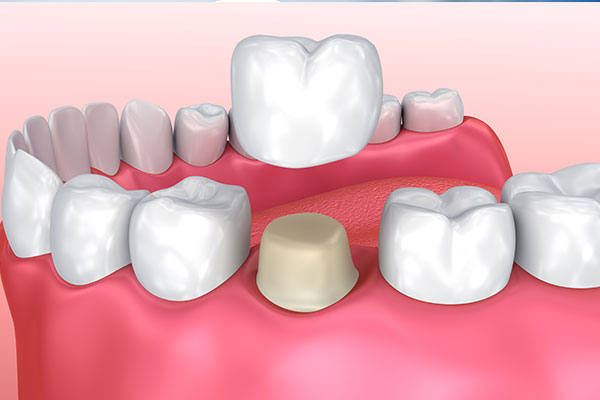 Smile Makeover With Your Brandon, FL Cosmetic Dentistry | Dr. John M. Cherry, Jr., DMD - Brandon Dentist | brandon,cosmetic dentistry 3d model of crown being placed on to tooth during smile makeover