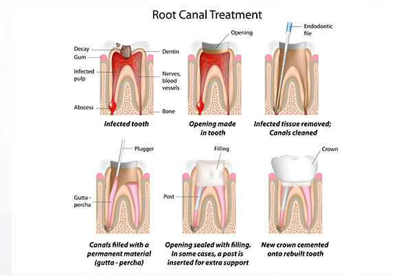 graphic of the stages of a root canal