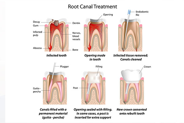 Root Canals | Dr. John M. Cherry, Jr., DMD - Brandon Dentist | graphic of the stages of a root canal