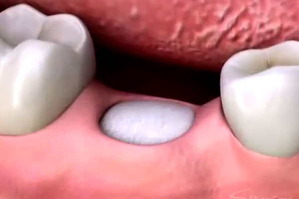 Smile Makeover With Your Brandon, FL Cosmetic Dentistry | Dr. John M. Cherry, Jr., DMD - Brandon Dentist | brandon,cosmetic dentistry 3d model of a worn down or extracted tooth