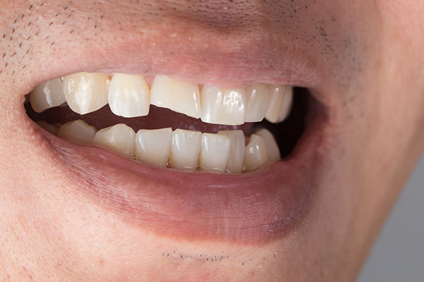 Porcelain Veneers | Dr. John M. Cherry, Jr., DMD - Brandon Dentist | chipped teeth need veneers