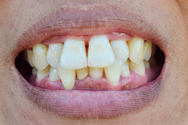 Porcelain Veneers | Dr. John M. Cherry, Jr., DMD - Brandon Dentist | persons yellowed misaligned teeth and receded gums
