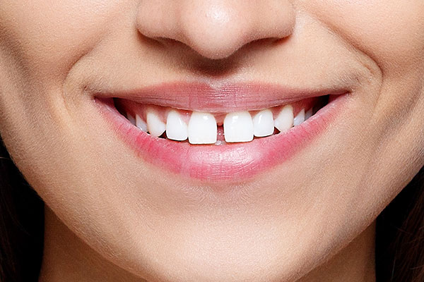 Porcelain Veneers | Dr. John M. Cherry, Jr., DMD - Brandon Dentist | gap in front two teeth needs porcelain veneers