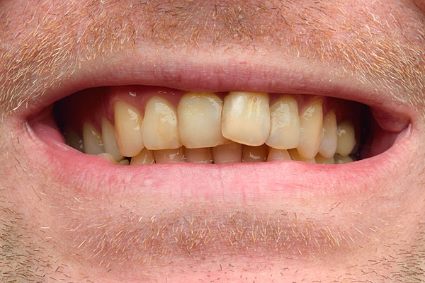 yellow crooked teeth need porcelain veneers