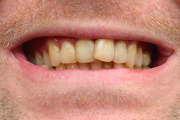 Porcelain Veneers | Dr. John M. Cherry, Jr., DMD - Brandon Dentist | yellow crooked teeth need porcelain veneers