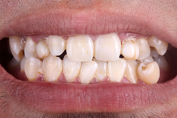 Porcelain Veneers | Dr. John M. Cherry, Jr., DMD - Brandon Dentist | crooked teeth