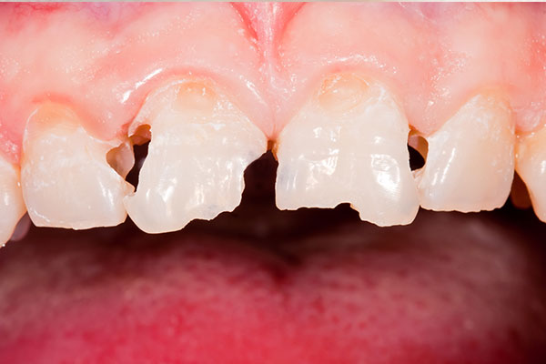 Porcelain Veneers | Dr. John M. Cherry, Jr., DMD - Brandon Dentist | chipped away and worn down teeth