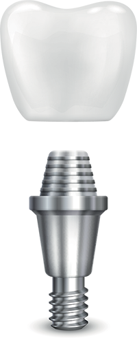 Dental Implants in Brandon, Florida | Dr. John M. Cherry, Jr., DMD - Brandon Dentist | dental implants transparent background 3d graphic of dental implant