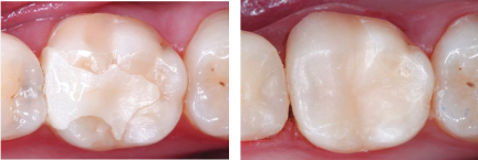 Same-Visit Crowns | Dr. John M. Cherry, Jr., DMD - Brandon Dentist | tooth colored fillings side by side