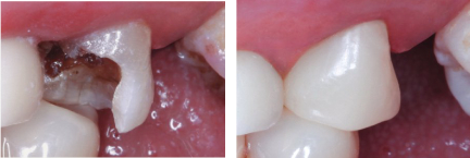 tooth before and after crown