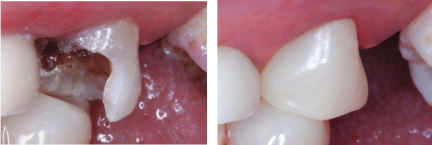 Same-Visit Crowns | Dr. John M. Cherry, Jr., DMD - Brandon Dentist | tooth before and after crown