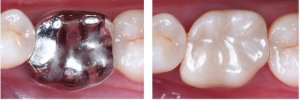 dental crowns tooth colored vs silver side by side