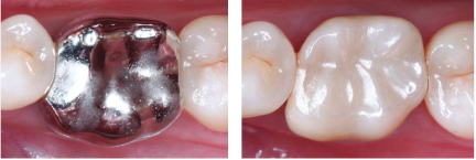 Same-Visit Crowns | Dr. John M. Cherry, Jr., DMD - Brandon Dentist | dental crowns tooth colored vs silver side by side