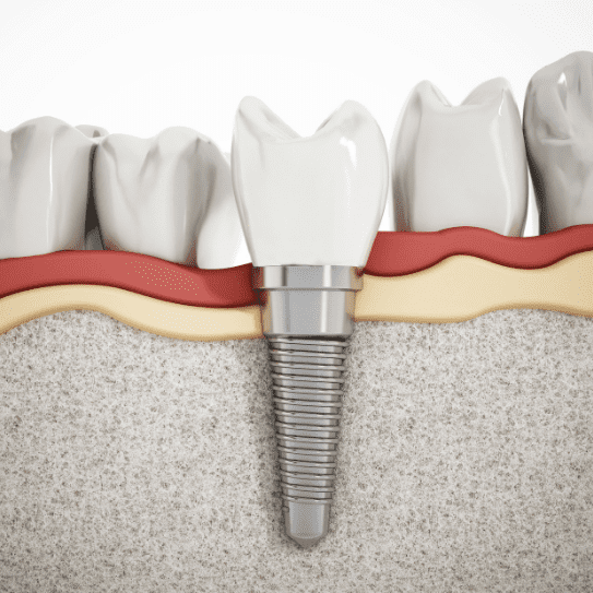 dental implants brandon florida