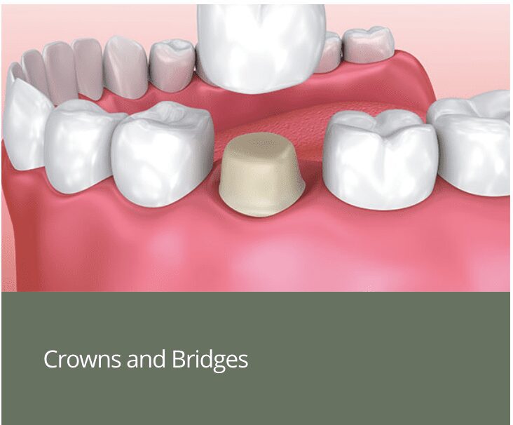 Crowns-and-Bridges