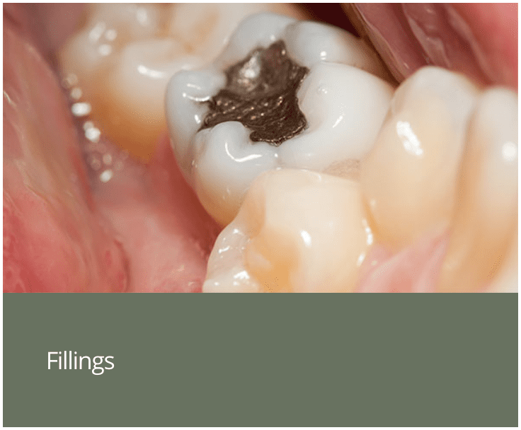 Fillings