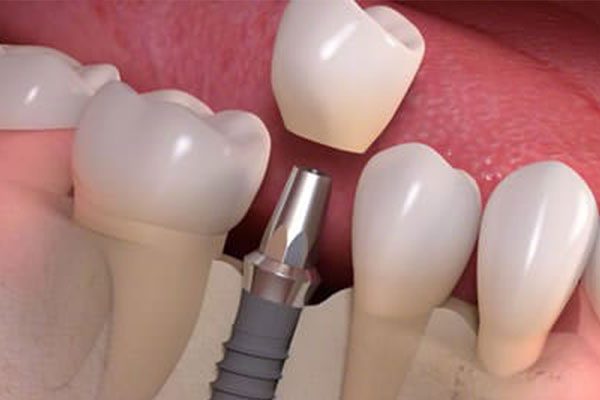 Dr. John Cherry, Jr., DMD - dental implants