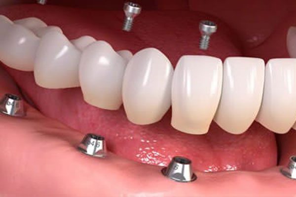 Dr. John Cherry, Jr., DMD - dental implants