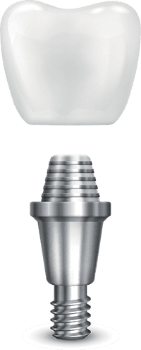 Dr. John Cherry, Jr., DMD - dental implants