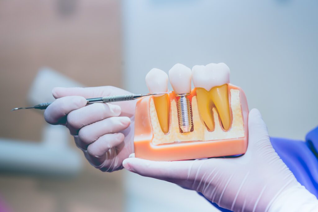 Dentist in Brandon FL, dental implants
