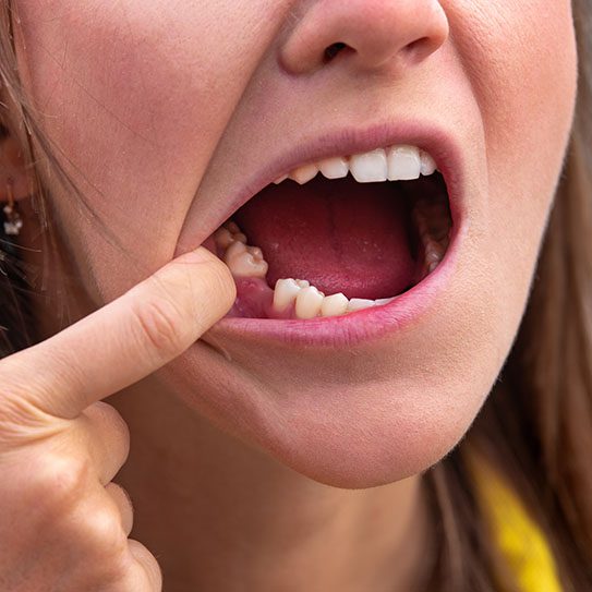dental implants tooth extractions near me dentist in Brandon FL