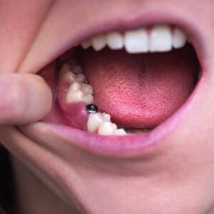 dental implants dental crowns near me Brandon Fl dentist